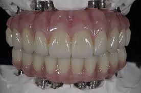 Laboratorio Dental Arcodent cerámica