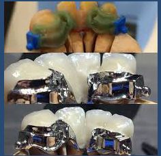 Laboratorio Dental Arcodent removible combinado