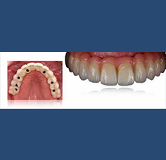 Laboratorio Dental Arcodent dientes