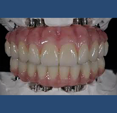 Laboratorio Dental Arcodent implantes