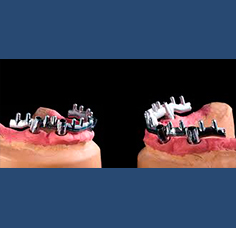 Laboratorio Dental Arcodent Prótesis híbridas