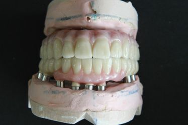 Laboratorio Dental Arcodent metal cerámica